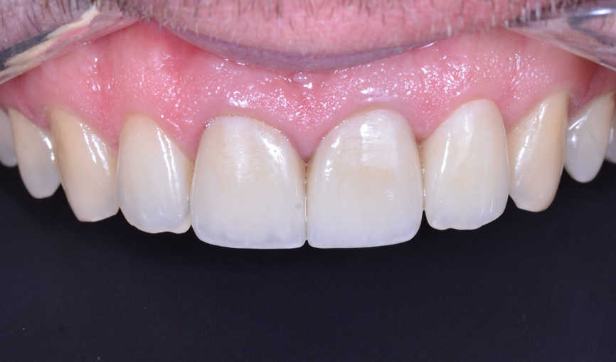 E-max коронки на 3 зуба